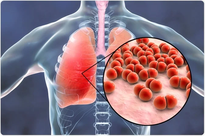 Fig: Pneumonia disease